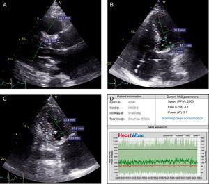 A–C: Transthoracic echocardiogram following implantation. A: Parasternal long-axis view; left ventricular end-diastolic diameter (46.9 mm), right ventricular diameter (36.1 mm at this level). B: Apical 4-chamber view; end-diastolic diameter of the basal (45.3 mm) and middle (31 mm) left ventricle. C: Apical 2-chamber view; end-diastolic diameter of the basal (45.2 mm) and middle (30.4 mm) left ventricle. D: HeartWare HVAD programming; normal parameters with circadian rhythm and no low-flow events. LPM, liters per minute; RPM, revolutions per minute; W, watts.