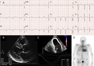 Diagnostic techniques in transthyretin cardiac amyloidosis (ATTR). A: electrocardiogram of a patient with wild-type transthyretin amyloidosis (ATTRwt), showing atrial fibrillation and pseudoinfarct pattern in inferior leads. B: echocardiogram of a patient with mutant transthyretin amyloidosis with Val30Met mutation, with marked concentric left ventricular hypertrophy and mild pericardial effusion. C: longitudinal regional strain of patient with ATTRwt, showing preserved values in the apical segment and depressed values in the basal and midventricular segments. D, 99mTc-DPD (99mTc-3,3-diphosphono-1,2-propanodicarboxylic acid) scan of a patient with ATTRwt, showing biventricular uptake superior to bone uptake, corresponding to Perugini grade 3.