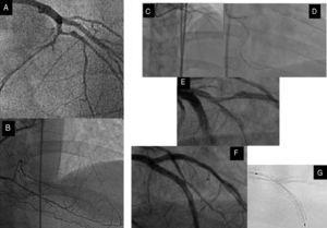 Left anterior descending artery CTO with a significant diagonal branch in the proximal cap (A) and distal filling by collaterals from the RCA (B). C: retrograde approach through a septal channel. D: retrograde guidewire directly crossed to the true lumen and introduced into the guide catheter. E: after predilation, an important dissection crossing bifurcation site was observed. F: this fact, together with the existence of a large lesion in the SB, dictated the strategy and a minicrush was performed with a good angiographic result. G: assessment of the enhancement stent visualization. CTO, coronary chronic total occlusion; RCA, right coronary artery; SB, side branch.