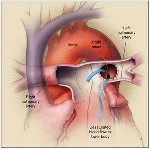 The Potts shunt procedure. The left pulmonary artery is anastomosed to the descending aorta, allowing the desaturated blood to go from the left pulmonary artery to the lower part of the body (arrow). The right pulmonary artery passes in front of the ascending aorta because an arterial-switch procedure has been performed. Reproduced with permission from Blanc et al.55