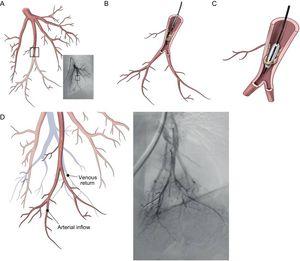 Percutaneous balloon pulmonary angioplasty procedure. A: Pulmonary angiography, showing a stenosis in the subsegment of the 10th segmental artery (anterior view). B: The catheter is introduced into a web stenosis. C: The wire is introduced between the fibrotic material and the balloon is inflated, leading to rupture of the web. D: Angiography after balloon pulmonary angioplasty shows an improvement of blood flow with better perfusion of the parenchyma and quick venous return. In contrast to pulmonary endarterectomy, the fibrous material is not removed from the arteries, but is crushed against the vessel wall. Reprinted with permission from Lang et al.15
