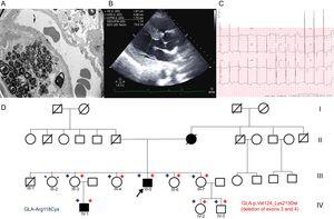 A: Electron microscopy of kidney biopsy with zebra bodies. B: Echocardiogram of the index case with LVH. C: Electrocardiogram of index case with LVH and short PR interval. D: Family tree; square, male; circle, female; in boldface, phenotype involvement; arrow, proband; diagonal, dead;+red, carrier of exon 3 and 4 deletion; -red, noncarrier of exon 3 and 4 deletion;+blue, carrier of p.Arg118Cys variant; blue, noncarrier of the p.Arg118Cys variant. LVH, left ventricular hypertrophy.