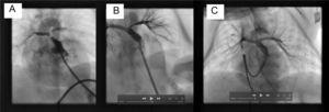 A, Right ventriculogram with cranial angulation in the posteroanterior view shows minimal anterograde pulmonary flow and the confluence of the trunk and the hypoplastic pulmonary branches. B, Pulmonary arteriogram with cranial angulation in the posteroanterior view depicts correct stent placement and adequate perfusion of both pulmonary branches, although with hypoplasia of the left pulmonary branch. C, The posteroanterior pulmonary arteriography image with cranial angulation at the second catheterization shows that both pulmonary branches have grown and there is adequate perfusion of the lung segments.