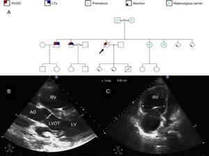 A: familial pedigree. Black arrow identifies our patient. B: transthoracic echocardiogram parasternal long axis view. Severely dilated and hypertrophic RV. C: transthoracic echocardiogram 4-chamber view. Severely dilated RV. AO, aorta; LTx, lung transplantation; LV, left ventricle; LVOT, left ventricular outflow tract; PVOD, pulmonary veno-occlusive disease; RV, right ventricle.