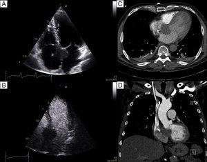 A: transthoracic echocardiography revealing the nodular mass in the interatrial septum, near the mitral and tricuspid valves, without opacification after ultrasonographic contrast administration (B). C, D: computed tomography displayed the 36 × 37mm mass with a density similar to that of the interventricular septum.