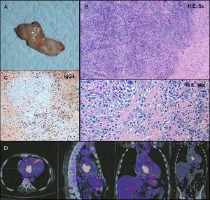 A: macroscopic appearance of the surgical specimen. B: hematoxylin-eosin (HE) staining demonstrated a fibrotic lesion with a storiform pattern and a rich inflammatory infiltrate. C: a large population of plasma cells was evidenced on immunohistochemistry, with an elevated number of IgG4-producing cells (274 per high power field). D: positron emission tomography scan confirmed the hypermetabolic cardiac lesion, without extracardiac involvement.