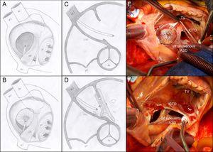 Schematic representation of iCTD and ASD without retroaortic border and with misalignment. Viewed from the right atrium without the device (A) and during deployment of the left disc (B). Transesophageal echocardiography, short-axis basal view at 45° without (C) and with (D) the device. The membrane does not allow ready adaptation of the right disc, and so the risk of embolization is increased. E and F, surgery; ASD in the inferior venous sinus, iCDT and device closing the fossa ovale (E) and after withdrawing the device (F). Ao, aorta; ASD, atrial septal defect; iCDT, incomplete cor triatriatum dexter; IVC, inferior vena cava; SVC, superior vena cava; TV, tricuspid valve.