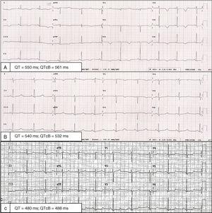 Electrocardiogram: at admission (A), at hospital discharge (B), and 6 months later (C). QTcB, QT interval corrected with Bazett formula.
