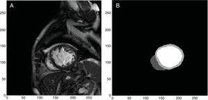 Example of automatic segmentation and identification of the left and right ventricle through deep learning performed in our department from images obtained with a 1.5-T Philips Achieva resonance system.12 From original images (A), the free neural network13 was able to identify and segment the left and right ventricles (B, white color for the left ventricle, light gray color for the myocardium of the left ventricle, and dark gray color for the right ventricle).