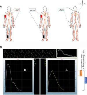 A: common methods to measure arterial stiffness. Left: carotid-ankle vascular index (CAVI). Center: brachial-ankle pulse wave velocity (baPWV). Right: carotid-femoral pulse wave velocity (cfPWV). Pictured on the right is the use of a tonometer to obtain the vascular waveform; however, a cuff can also used in both the carotid and the femoral locations. B: derivation of central augmentation index. The panel has 2 assembled waveforms labeled radial (“R”) and aortic (“A”). The operator records 10seconds of radial waveform shown in the upper portion of panel B. The waveform is calibrated by entering the brachial blood pressure at the time of measurement. The software uses an algorithm to estimate the central pressure waveform using the radial waveform data and displays the central aortic pressure waveform on the right. In this example, the brachial blood pressure was 130/96mmHg. The central aortic pressure is 122/97mmHg. The pulse pressure in the central aortic waveform, shown in the blue bracket, is 25mmHg (calculated as the systolic minus the diastolic value). The central aortic waveform upstroke clearly changes slope at 116mmHg, marked by a green dot on the right border of the aortic waveform. The systolic value (122mmHg) minus the value at the deflection point (116mmHg) yields a difference of 6mmHg shown in the orange bracket, representing the augmentation pressure experienced by the left ventricle when completing systole. This augmentation pressure results from the backward-traveling pressure wave, which arrives at the left ventricle in late systole and contributes to the final central pressure waveform. The central augmentation index is the ratio of this augmented pressure divided by the aortic pulse pressure.