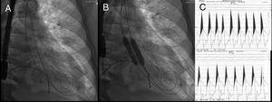 Fluoroscopy. A: transitory pacemaker placed in the right ventricle and two 275cm high support, preshaped guidewires in the left ventricle. B: deployment of 10 × 40mm and 12 × 40mm Armada 35 (Abbot Vascular, Chicago, United States) angioplasty balloons within the aortic annulus. C: hemodynamics: top, pre-BAV aortic gradient; bottom: post-BAV aortic gradient (19mmHg reduction). BAV, balloon aortic valvuloplasty.
