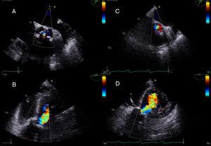 Transoesophageal echocardiography, short and long axis. A and B: pre-BAV mild aortic regurgitation. C and D: post-BAV moderate-aortic regurgitation. BAV, balloon aortic valvuloplasty.
