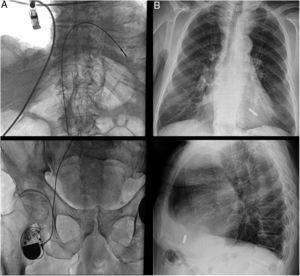 Alternative cardiac pacing approaches. A: femoral approach to single-chamber right-ventricular pacing in a 90-year-old male patient with occlusion of the superior vena cava following previous device and lead removal interventions for recurrent device-related infection. The pacemaker had been implanted prior to the market release of the leadless pacemakers. B: “less is more”: leadless cardiac pacing in an 86-year-old male patient with persistent atrial fibrillation and atrioventricular block.
