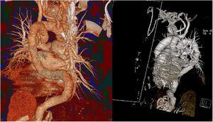 Three-dimensional reconstructed multidetector computed tomographic images showing the tortuosity of ascending aorta, aortic arch, descending aorta, pulmonary branches and supra-aortic trunks. The aortic arch shows the meandering vessels sign.