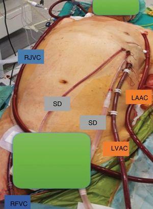 Cannulation and drainage setup following biventricular assist device implantation. LAAC, left axillary artery cannula (left ventricular assist device [LVAD] return cannula); RFVC, right femoral vein cannula (right ventricular assist device [RVAD] drainage cannula); LVAC, left ventricular apex cannula (LVAD drainage cannula); RJVC, right jugular vein cannula (RVAD return cannula); SD, surgical drain.