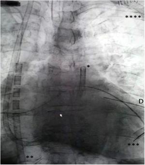Chest radiograph following biventricular assist device implantation. Right ventricular assist device return (*) and drainage (**) cannulas. Left ventricular assist device drainage (***) and return (****) cannulas.