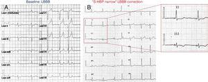 Case report: a 54-year-old woman with nonischemic cardiomyopathy, mild ejection fraction reduction. Pacing indication due to first and paroxysmal second degree atrioventricular block. A, baseline ECG and left bundle branch block (LBBB) morphology. B, ECG after 10 months of follow-up. The small window shows the narrow paced QRS (84ms). S-HBP, selective His bundle pacing.