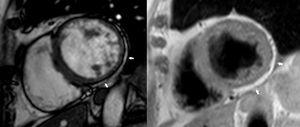 Short-axis still cine image and T1-weighted image showing myocardial thinning on the inferior and lateral walls at the expense of a circumferential band of subepicardial fatty infiltration (arrows).