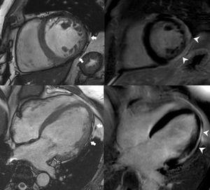 Short-axis still cine image (upper left) showing myocardial thinning on the inferior and lateral walls (arrows) and corresponding LGE image (upper right) in which subepicardial fibrosis can be demonstrated on those locations (arrowheads). Likewise, on the lower images, epicardial contour irregularities on the lateral wall can be demonstrated (arrows) on the 4-chamber still cine image (lower left) and fibrosis in the same location (arrowheads) on the LGE image (lower right). LGE, late gadolinium enhancement.