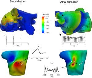 At the top, atrial propagation produced by a sinus rhythm (left) and by an ectopic pacing from the coronary sinus (right) and their electrogram signals registered at 1 intracavitary electrode. At the bottom, body surface potential maps at 1 instant of the above simulations and P-wave registered at the V3 precordial lead.