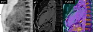 Fused positron emission tomography (PET)/magnetic resonance (MR) image shows active inflammation in the areas of fibrosis (arrows), consistent with reactivation of previous myocarditis.