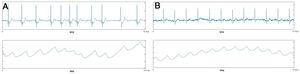 RITHMI heart rhythm monitor output for a patient with atrial fibrillation (A) and sinus rhythm (B). ECG, electrocardiogram; PPG, photoplethysmography.