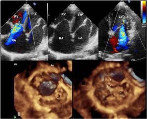 TTE images on apical 4-chamber view. A: displacement of the septal leaflet of the tricuspid valve and moderate tricuspid regurgitation on color Doppler. B: 3DTTE reconstruction from the ventricular view; both mitral orifices can be seen in diastole and systole, the larger, medial orifice has 2 leaflets: anterior (1) and posterior (2); the smaller, lateral and more apical leaflet has failure of coaptation. C: severe mitral regurgitation is observed originating at the smaller orifice (video 1 of supplementary data). Ao, aorta; LA, left atrium; LV; left ventricle; RA, right atrium; RV, right ventricle; TTE, transthoracic echocardiogram.