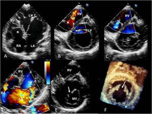 TTE on apical 4-chamber view showing displacement of the septal leaflet of the tricuspid valve (A) (black arrow) in relation to the mitral annulus (white arrow) and atrialization of the right ventricle (asterisk), and on parasternal short-axis view in diastole (B), limited movement of the anterior leaflet and displacement of the septal leaflet and mild regurgitation in systole (C). D: severe mitral regurgitation, dilatation of the left atrium, and patent foramen ovale. The 2D parasternal short-axis (E) and the 3D reconstruction from the ventricular surface (F) show the mitral cleft (arrow) that divides the anterior leaflet, running toward the left ventricular outflow tract. See video 2 of the supplementary data. Ao, aorta; LA, left atrium; LV, left ventricle; MV, mitral valve; RA, right atrium; RV, right ventricle; TTE, transthoracic echocardiography. This figure is shown in full color in the electronic version of the article.