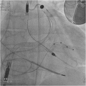 Fluoroscopy image after implantation of both Impella catheters (Bi-Pella), showing the Impella CP catheter inserted from the aorta into the left ventricle and the Impella RP catheter crossing the right ventricle from the inferior vena cava to the pulmonary artery.