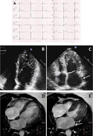 Complementary tests in the index patient. A: electrocardiography indicating sinus bradycardia. B: apical 4-chamber transthoracic echocardiography exhibiting deep apical hypertrabeculation in the left ventricle (asterisk). C: endsystolic frame showing left atrial dilatation (arrow). D: CMR showing biventricular hypertrabeculation (arrows) meeting LVNC criteria. E: CMR, with the endsystolic phase showing left atrial dilatation (arrow). CMR, cardiac magnetic resonance; LVNC, left ventricular noncompaction.