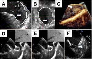 A-C, thrombos partly occupying the landing zone and tip of the left atrial appendage in patient #5. D and E, progressive deployment of device with echocardiographic guidance (patient #1) and care not to displace the thrombus. F, final position of device forming a cage around the thrombus.