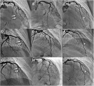 Coronary angiogram in the acute setting (before and after fenestration) and at follow-up at 6 months. The arrows indicate occlusion of the left anterior descending artery. The asterisks indicate images compatible with residual dissection.