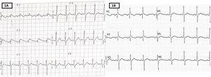 A: electrocardiogram on admission to the pediatric intensive care unit. ST-segment elevation in V1 and V2 (arrows), followed by a negative T wave (type 1 Brugada pattern). B: electrocardiogram at discharge.