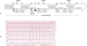 A. Timeline for the 3 last years of follow-up. B. A typical electrocardiogram recorded while the patient was on nadolol plus ranolazine. CA, cardiac arrest; C0, residual concentration; Fleca, flecainide; ICD, implantable cardioverter defibrillator; LCSD, left cardiac sympathetic denervation; Mex, mexiletine; And, nadolol; Ran, ranolazine. The thunder symbol represents ICD discharge.