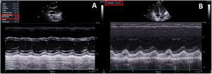 M-mode echocardiography 24hours after admission showing severe left (A) and right (B) ventricular dysfunction.