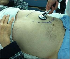 Auscultation of a typical fistula murmur in the splenic area (marked on the skin) of a patient with myeloproliferative syndrome with myelofibrosis by Dr Alonso-Pulpón in May 2011 in the Cardiology Department of the Hospital Puerta de Hierro.