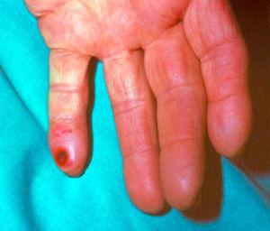 Trophic lesion in finger of Left hand, secondary to distal ischemia after humerus IAVF.