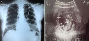 Radiografía de tórax al ingreso (A) y ultrasonido a las 12 semanas de gestación (B).
