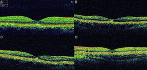 Optical coherence tomography (OCT) images of cases at presentation. In case 1 (A, spectral domain 3D OCT-2000, Topcon, Tokyo, Japan), there is a small disruption in the inner segment-outer segment (IS/OS) band in the fovea. In case 2 (B, time-domain Stratus OCT, Carl Zeiss Meditec, USA), a hyper-reflective area in the fovea affecting all retinal layers without increase in retinal thickness is detected. In case 3 (C, time-domain Stratus OCT, Carl Zeiss Meditec, USA), a small hyper-reflective area at the fovea can be appreciated. In case 4 (D, time-domain Stratus OCT, Carl Zeiss Meditec, USA), there is a defect in the inner hyper-reflective layer of the fovea.