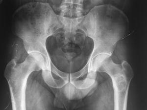 Radiografía anteroposterior simple de pelvis en la que se observa una lesión lítica geográfica bien delimitada, de borde esclerótico a la altura del fémur izquierdo, que respeta la cortical y con calcificaciones en su interior.