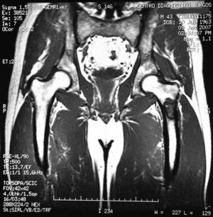 Corte coronal de resonancia magnética que muestra una tumoración con hiposeñal bien delimitada en la secuencia T1 en la cadera izquierda.