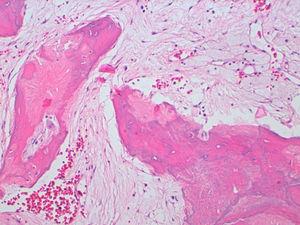 Imagen histológica en coloración de hematoxilina y eosina 40X en la que se observan las áreas de seudoPaget (matriz y trabéculas óseas sin revestimiento osteoblástico u osteoclástico) así como la estroma fibromixoide. Se señalan las áreas de seudoPaget.
