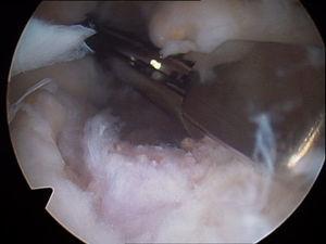 Imagen artroscópica de capsulotomía anterior con pinza basket. Tras la cápsula se observan las fibras del músculo brachialis (visión desde portal anterolateral).