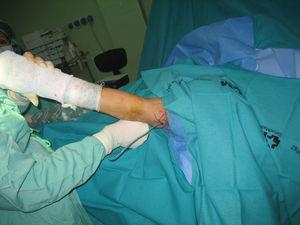 Imagen clínica con extensión postoperatoria. Esta paciente será inmovilizada en extensión guante un plazo de 48 h aproximadamente.