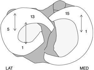 Caracterización de los fallos en la reparación meniscal con tornillos reabsorbibles. LAT: lateral; MED: medial.