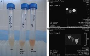 Pruebas de RMN. A) Tubos conteniendo las poblaciones celulares embebidas en gel de plasma rico en plaquetas (PRP). B y C) De izquierda a derecha se muestran las imágenes de RMN del PRP, PRP con ADMSCs marcadas con SPIO, y PRP con población celular control.