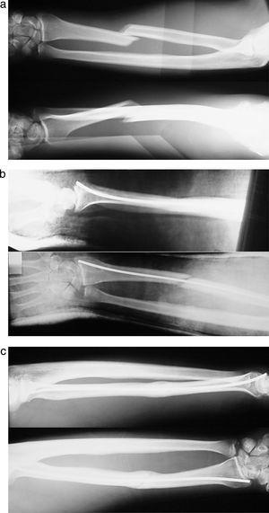 a. Rx preoperatoria fractura diafisaria radio. b. Resultados postoperatorios inmediatos. c. Rx a los 3 meses. Consolidación ósea.