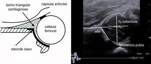 Parámetros ecográficos de estudio: ángulo alfa, porcentaje de cobertura de la cabeza femoral y distancia a pubis.