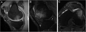 Imágenes representativas de RM que muestran la aparición de edema óseo subcondral en 2 pacientes después de 12 meses (A) y 24 meses (B y C) del tratamiento con implante de condrocitos autólogos de alta densidad (HD-ACI). A) Edema subcondral en zona de carga de cóndilo femoral interno, con menisco integro e irregularidad en hueso subcondral (corte sagital). Corte sagital (B) y corte axial (C) de imágenes de RM de un paciente con edema óseo en el cóndilo femoral externo (tróclea) en las que se observa una buena integración del implante de condrocitos con el hueso subcondral.