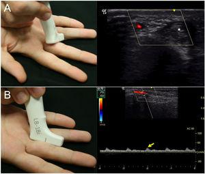A)Procedimiento de medida del diámetro de la arteria digital ulnar del tercer dedo de la mano derecha. Medida proximal a la articulación IFP. Se coloca la sonda en transversal para localizar la arteria que se encuentra adyacente a los tendones flexores (asterisco). B)Procedimiento de medida de la velocidad de flujo de la arteria digital ulnar del tercer dedo de la mano derecha. Medida proximal a la articulación IFP. Se coloca la sonda en longitudinal para localizar la arteria y se toma el valor del pico sistólico si el pulso era regular (flecha amarilla).